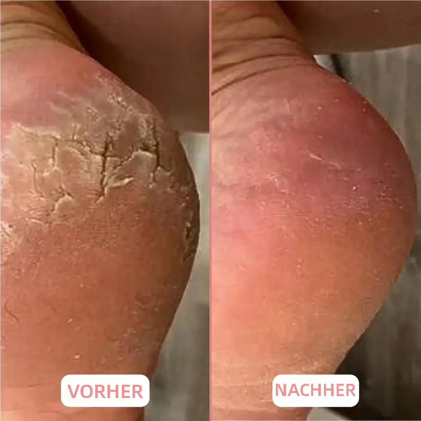 🍯 HoneyBalm™ – Feuchtigkeitsbalsam mit Honig für die Füße