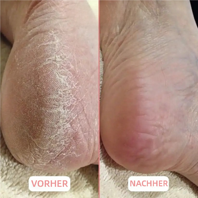 🍯 HoneyBalm™ – Feuchtigkeitsbalsam mit Honig für die Füße